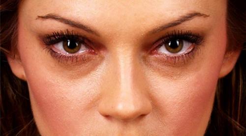 Как убрать мешки и синяки под глазами дома. Мешки под глазами: причины появления 02 Как убрать мешки и синяки под глазами дома. Мешки под глазами: причины появления 02