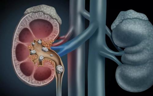 Как долго выходят камни из почек и могут ли они растворяться. Ускорение выхода камней из почек – насколько это безопасно 01