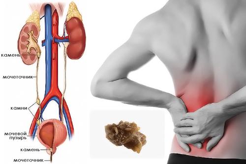 Как долго выходят камни из почек и могут ли они растворяться. Ускорение выхода камней из почек – насколько это безопасно 07