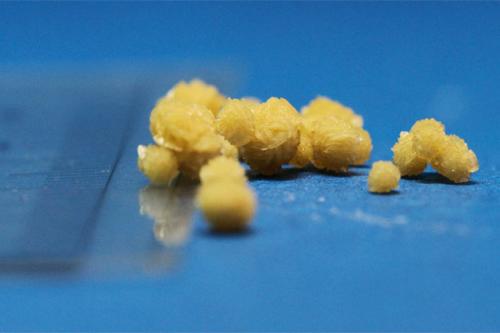 Как долго выходят камни из почек и могут ли они растворяться. Ускорение выхода камней из почек – насколько это безопасно 05