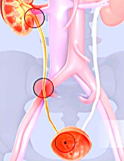 Как долго выходят камни из почек и могут ли они растворяться. Ускорение выхода камней из почек – насколько это безопасно 04