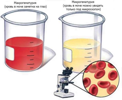 Как долго выходят камни из почек и могут ли они растворяться. Ускорение выхода камней из почек – насколько это безопасно 03