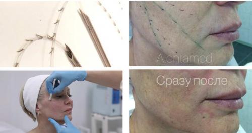 Как можно устранить носогубные морщины. Нити в носогубные складки (нитевой лифтинг).