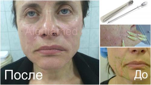 Как можно устранить носогубные морщины. Нити в носогубные складки (нитевой лифтинг).