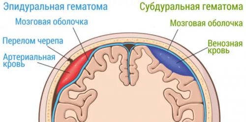 Как избавиться от синяков под глазами от удара. Классификация