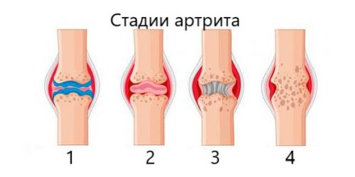 Восстановление суставов после ковида: основные принципы и рекомендации 01 Восстановление суставов после ковида: основные принципы и рекомендации 01