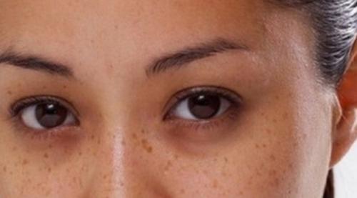 Как убрать синяки под глазами. Синяки под глазами появляются по ряду причин 02 Как убрать синяки под глазами. Синяки под глазами появляются по ряду причин 02