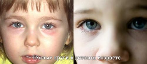 Темные круги вокруг глаз симптомы. Давайте взглянем на анатомическое строение области глаз.