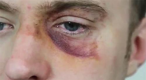 Убрать синяк под глазом за один день. Как быстро убрать синяк под глазом за один день