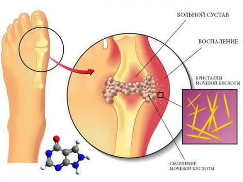 Суставы слабые, что делать. Правильный режим нагрузок 02 Суставы слабые, что делать. Правильный режим нагрузок 02