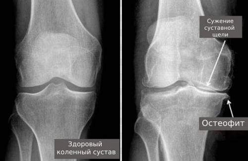 Суставы слабые, что делать. Правильный режим нагрузок 01 Суставы слабые, что делать. Правильный режим нагрузок 01