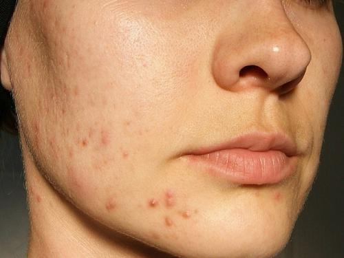 Лосьон для сухой и пересушенной проблемной кожи. Правильный уход за жирной и проблемной кожей лица 14 Лосьон для сухой и пересушенной проблемной кожи. Правильный уход за жирной и проблемной кожей лица 14