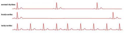 Лечение нарушений ритма сердца. Фибрилляция и трепетание предсердий 05 Лечение нарушений ритма сердца. Фибрилляция и трепетание предсердий 05