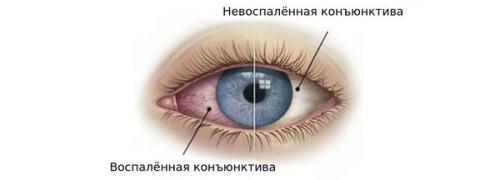 Чем лечится конъюнктивит у взрослых? Острый конъюнктивит: лечение и прогноз 01