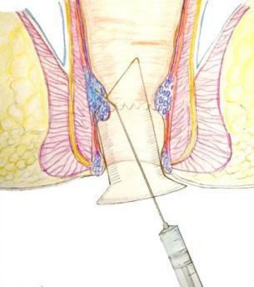 Мазь при геморрое и трещинах. Лучшие мази от геморроя 01