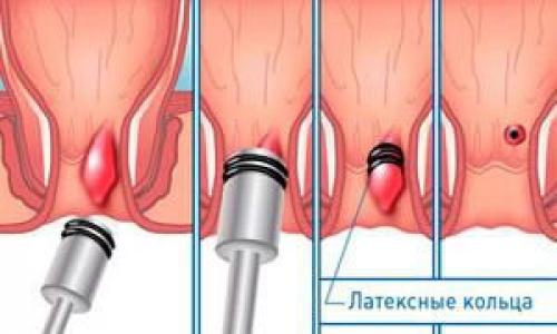 Мазь при геморрое и трещинах. Лучшие мази от геморроя 02