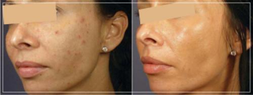 Что такое механическая чистка лица и как она делается. Как происходит процесс механической чистки лица у косметолога 11 Что такое механическая чистка лица и как она делается. Как происходит процесс механической чистки лица у косметолога 11