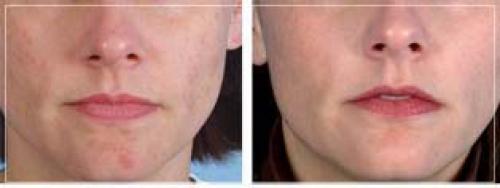 Что такое механическая чистка лица и как она делается. Как происходит процесс механической чистки лица у косметолога 10 Что такое механическая чистка лица и как она делается. Как происходит процесс механической чистки лица у косметолога 10