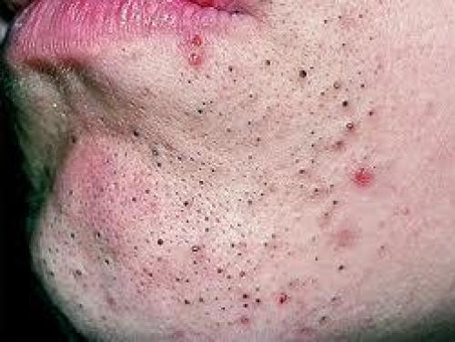 КАК МГНОВЕННО избавиться от чёрных точек. Почему они появляются 06 КАК МГНОВЕННО избавиться от чёрных точек. Почему они появляются 06