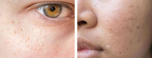 Как избавиться от рубцов после прыщей. Причины возникновения и виды шрамов после прыщей 05 Как избавиться от рубцов после прыщей. Причины возникновения и виды шрамов после прыщей 05