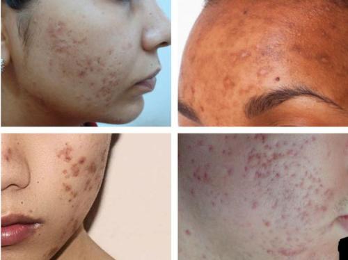 Как избавиться от рубцов после прыщей. Причины возникновения и виды шрамов после прыщей 03 Как избавиться от рубцов после прыщей. Причины возникновения и виды шрамов после прыщей 03