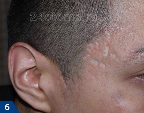 Можно ли убрать рубцы на лице. Виды шрамов (рубцов) –