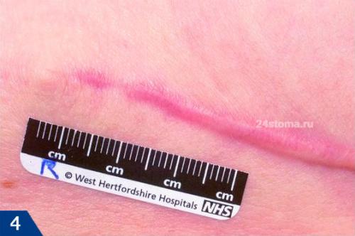 Как убрать рубцы от прыщей. Виды шрамов (рубцов) –