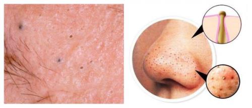 Как избавиться от рубцов постакне. Симптомы постакне 03 Как избавиться от рубцов постакне. Симптомы постакне 03