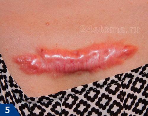 Как убрать рубцы от прыщей. Виды шрамов (рубцов) –