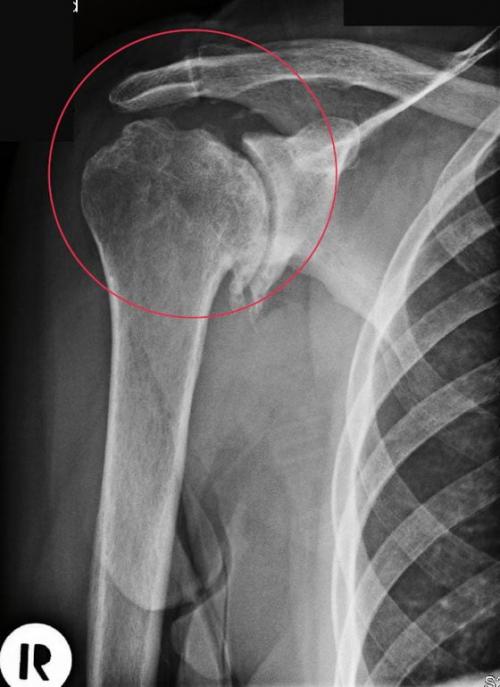 Хрустит плечо при вращении, что делать. Остеоартроз