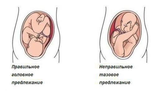 Дисплазия код по мк. Степени дисплазии 05 Дисплазия код по мк. Степени дисплазии 05