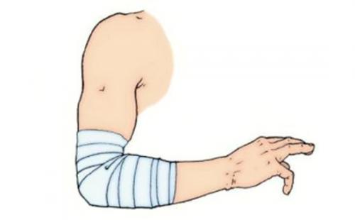 Как повязка черепашья расходящаяся появилась. Показания и правила использования черепашьей повязки