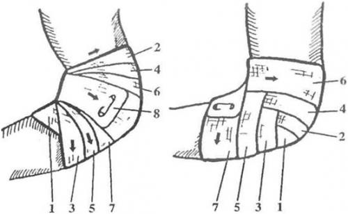 Что такое повязка черепашья расходящаяся. Сходящаяся и расходящаяся черепашья повязка на локоть и колено