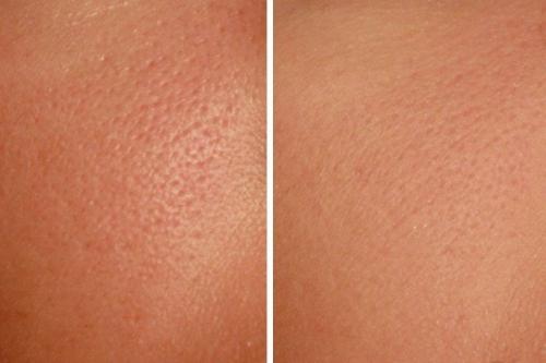 Расширение поры и черные точки. Как бороться с расширенными порами в домашних условиях 01 Расширение поры и черные точки. Как бороться с расширенными порами в домашних условиях 01