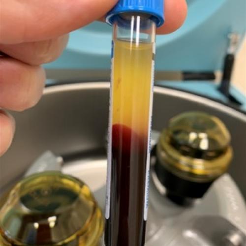 Укол в колено гиалуроновой кислоты последствия. Какие препараты вводят в сустав и с какой целью 05