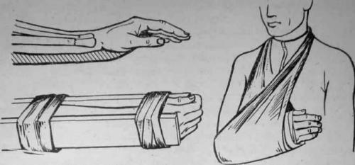 Как понять, что сломана рука ниже локтя. Определение болезни. Причины заболевания 02