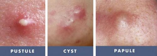 Как избавиться от постакне. Определение болезни. Причины заболевания 01 Как избавиться от постакне. Определение болезни. Причины заболевания 01