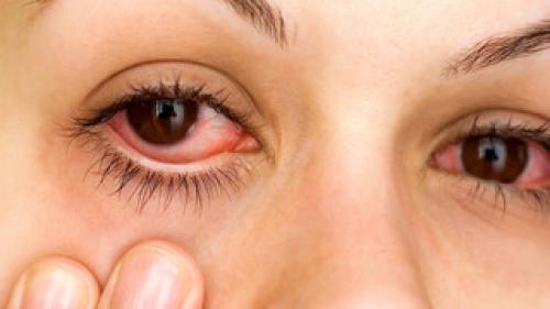 Воспалительные заболевания глаз. Основные симптомы 07