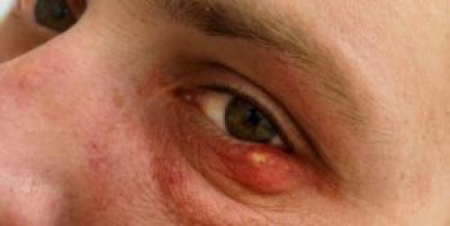 Воспалительные заболевания глаз список. Список заболеваний глаз у человека — описание симптомов