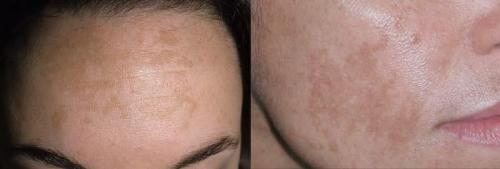 Как убрать пигментные пятна. Как удалить пигментацию на лице 01