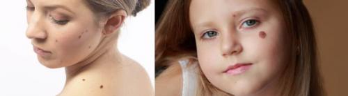 Как убрать пигментные пятна. Как удалить пигментацию на лице 03