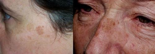 Как убрать пигментные пятна. Как удалить пигментацию на лице 02