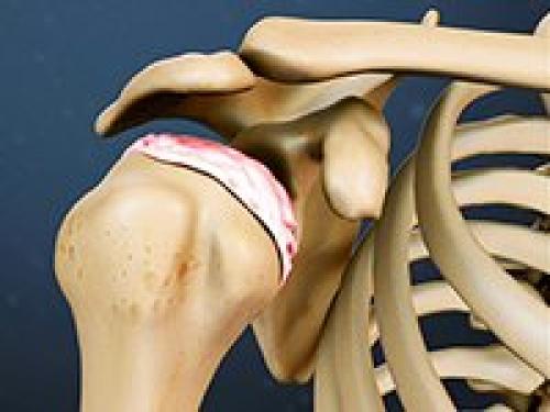 Лечение деформирующего артроза плечевого сустава. Как вовремя установить диагноз 02