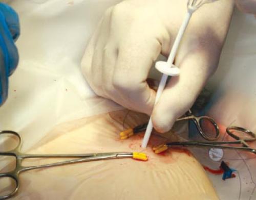 Какие продукты нельзя хранить в гипертостопе. 20 Вопросов и ответов по уходу за гастростомой и лечению осложнений