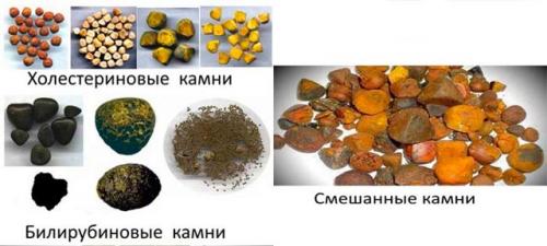 Как растворить камни в желчном пузыре без операции. Когда применяют лекарства