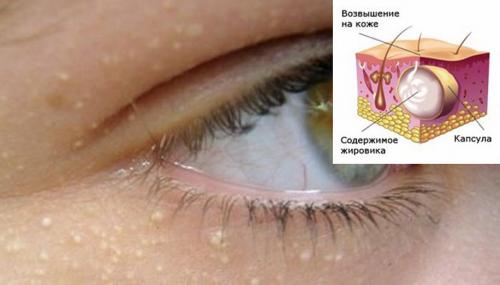 Какие причины могут стать причиной появления белых угрей под глазами. Почему под глазами появляются белые точки?