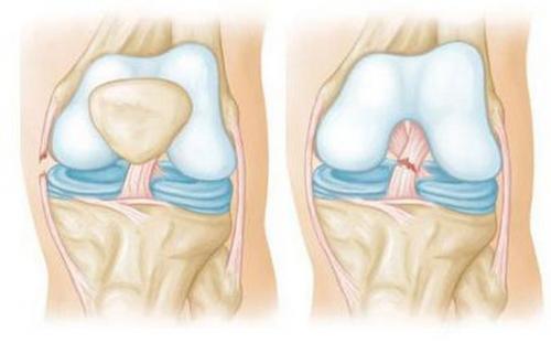Как часто и в каких дозировках рекомендуется употреблять желатин для здоровья суставов. Показания и противопоказания к применению