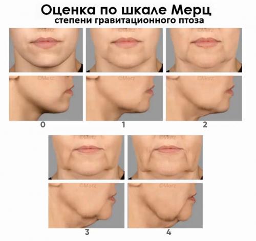 Какие методы помогают убрать брыли на лице. Нитевой лифтинг — самый разрекламированный способ убрать брыли