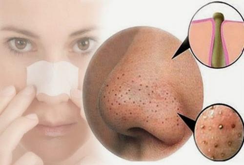 Могут ли маски для лица помочь в борьбе с черными точками. Правила нанесения масок