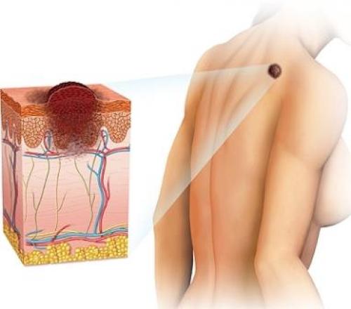 Опасные и неопасные родинки: как отличить их и защитить себя 01